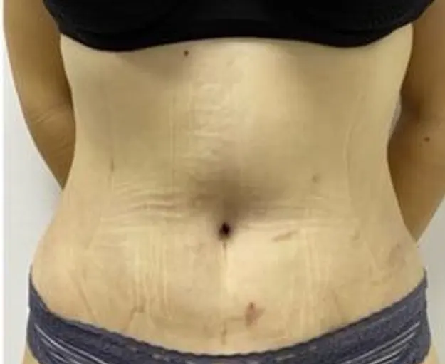  HD tummy tuck — after